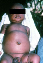 a child with swollen belly syndrome